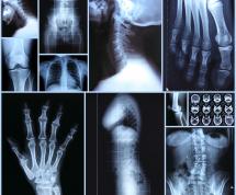 radiographic-image-skelton-anthropology-forensic-science-standards-sex-estimation